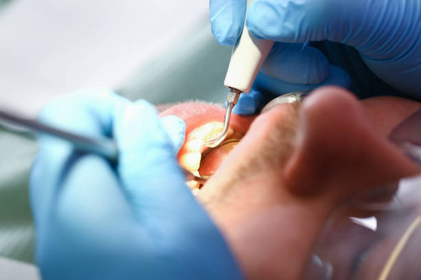 Best Emergency Root Canal Therapy in Bloomville, OH