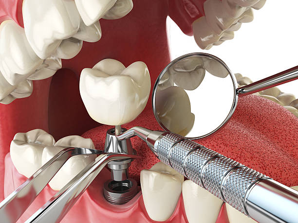 Best Knocked-Out Tooth (Avulsed Tooth) Treatment in Bloomville, OH